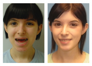 Before After 1