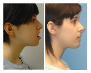 Before After 2