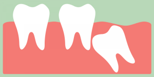 cartoon of impacted tooth