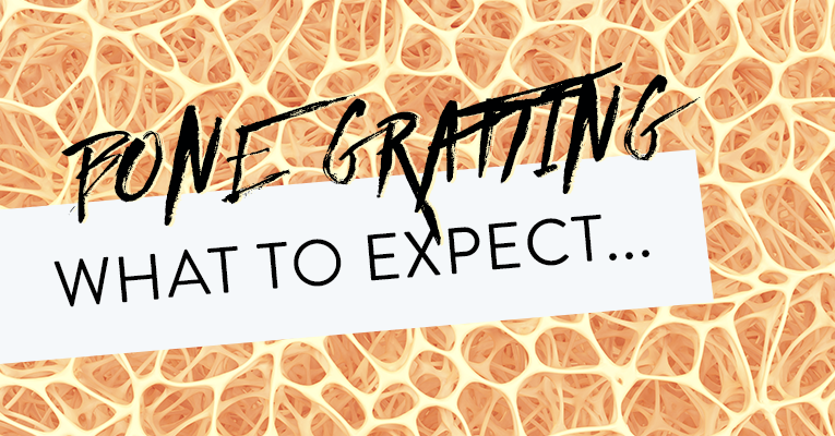 what to expect when expecting a bone graft
