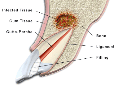 Apicoectomy Richmond VA