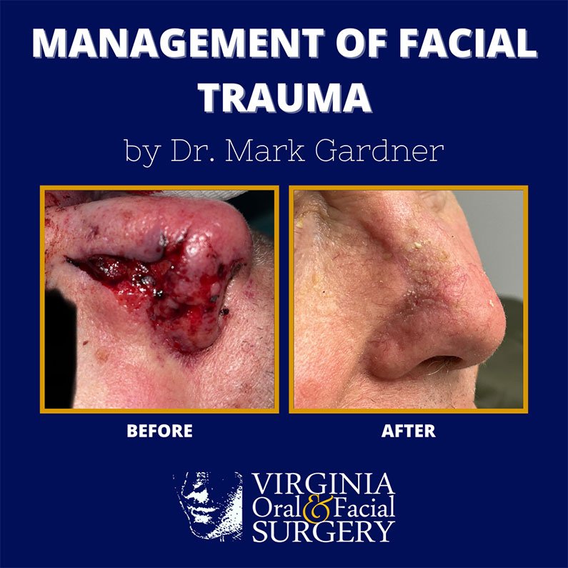 Before and after case - Facial Trauma