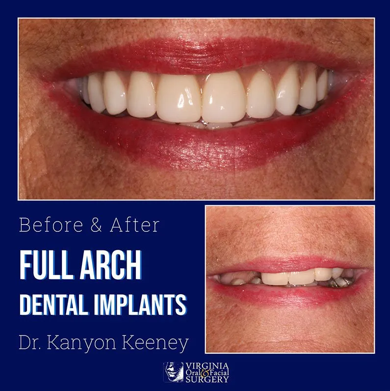 Before and after case - Full arch dental implants