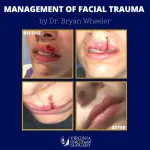 Before and after case - Facial Trauma