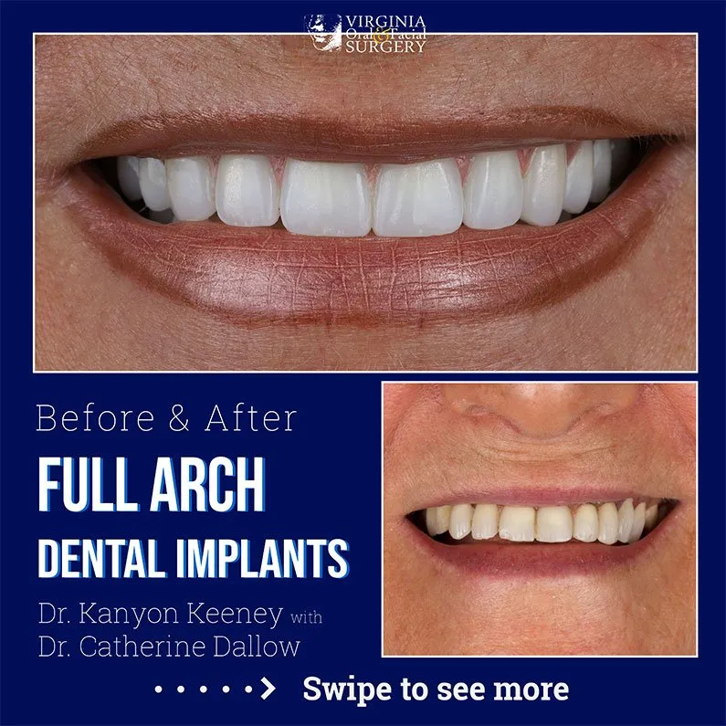 Before and after case - Full arch dental implants