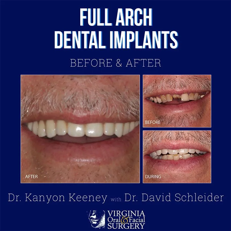 Before and after case - Full arch dental implants