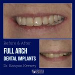 Before and after case - Full arch dental implants