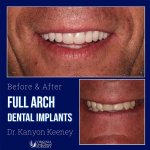 Before and after case - Full arch dental implants