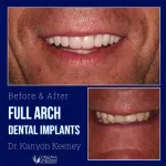 Before and after case - Full arch dental implants