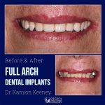 Before and after case - Full arch dental implants