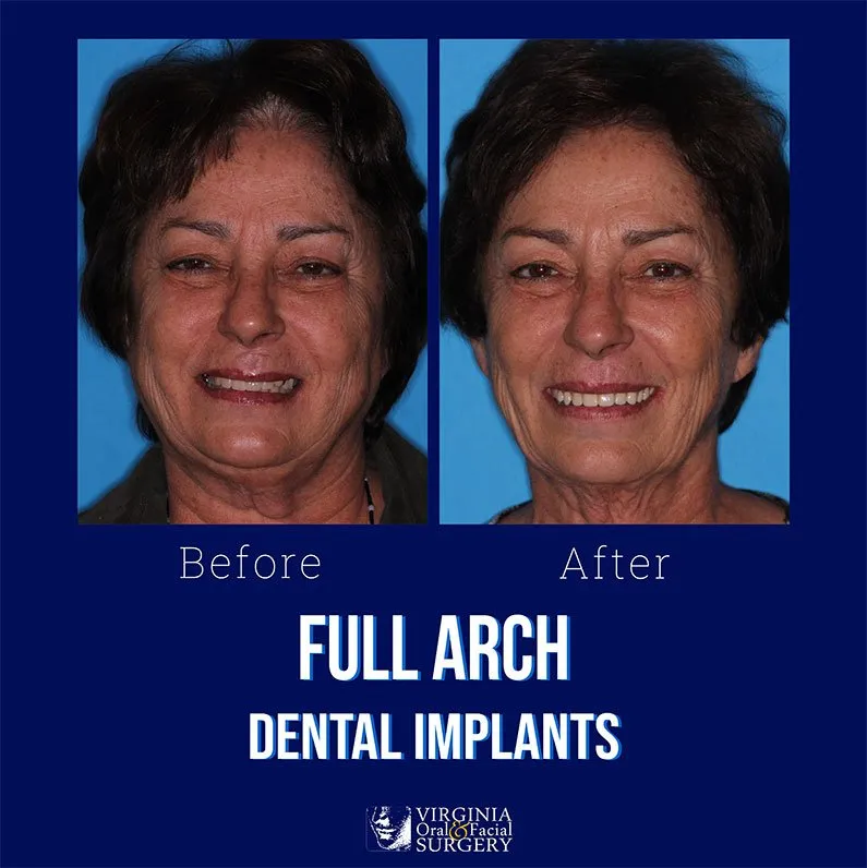 Before and after case - Full arch dental implants