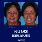 Before and after case - Full arch dental implants