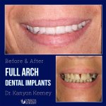 Before and after case - Full arch dental implants