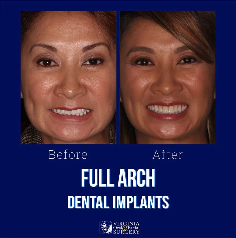 Before and after case - Full arch dental implants