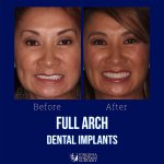 Before and after case - Full arch dental implants