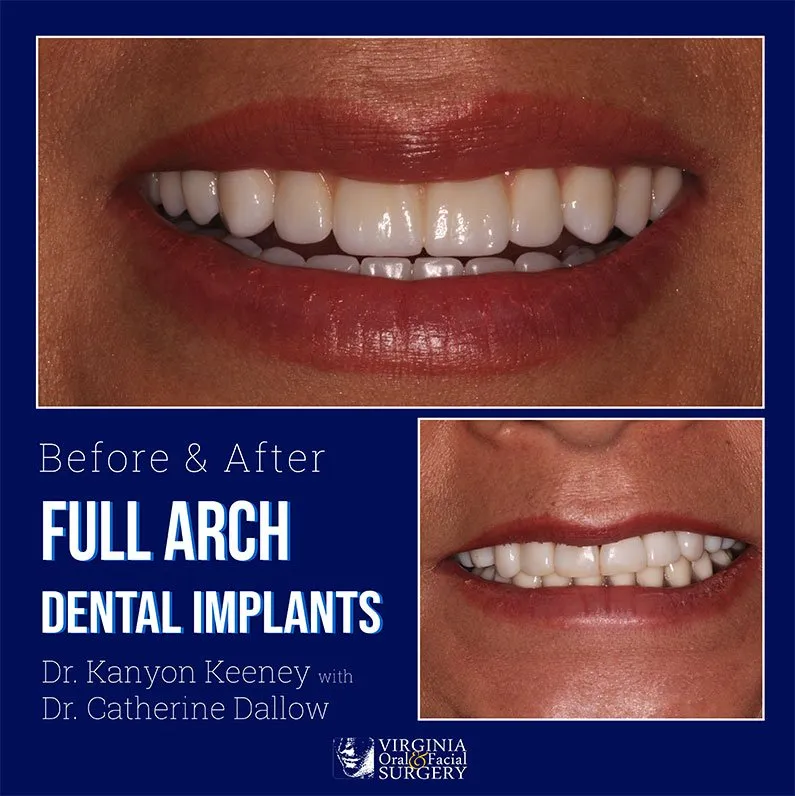 Before and after case - Full arch dental implants