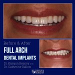 Before and after case - Full arch dental implants