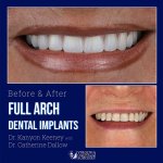 Before and after case - Full arch dental implants