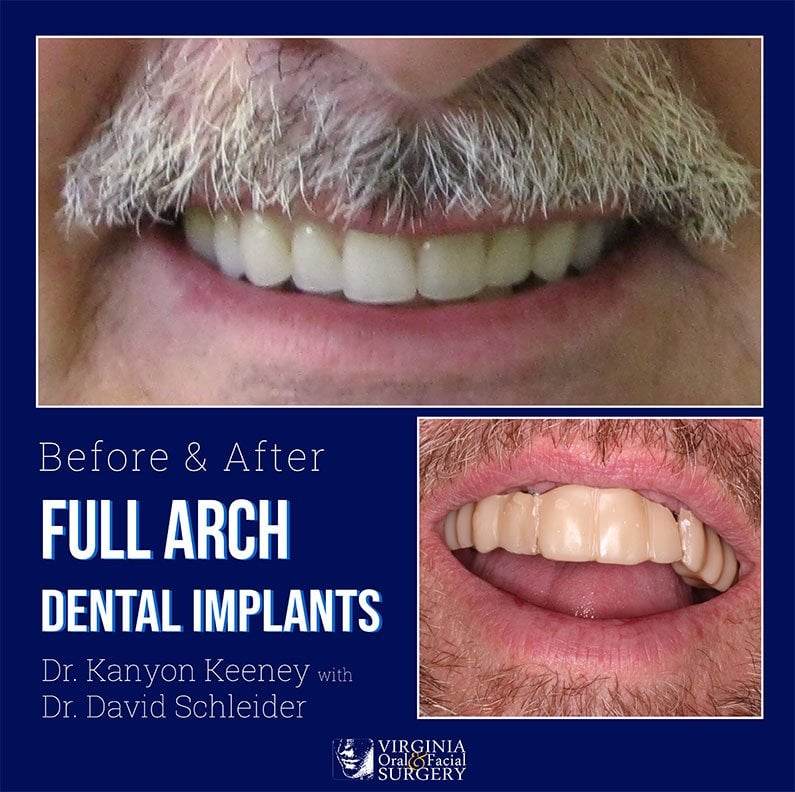 Before and after case - Full arch dental implants
