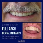 Before and after case - Full arch dental implants
