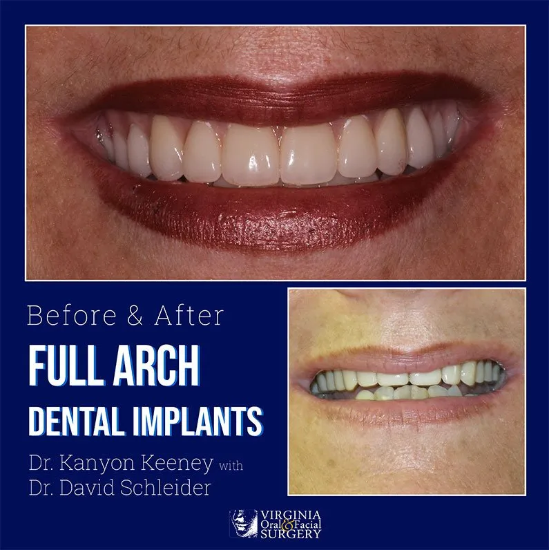 Before and after case - Full arch dental implants