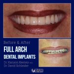 Before and after case - Full arch dental implants