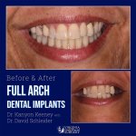 Before and after case - Full arch dental implants