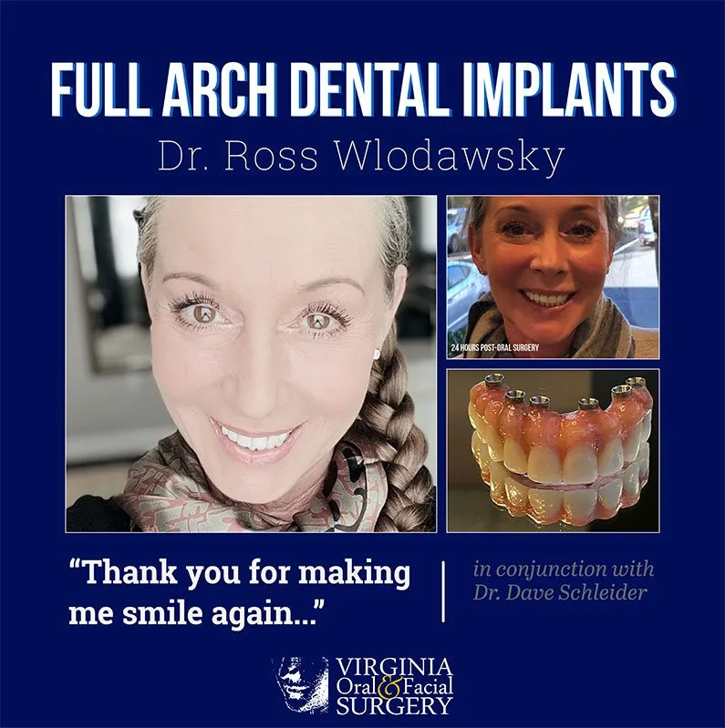Before and after case - Full arch dental implants