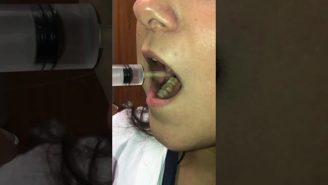 Irrigation of Wisdom Tooth Sockets Video Thumbnail